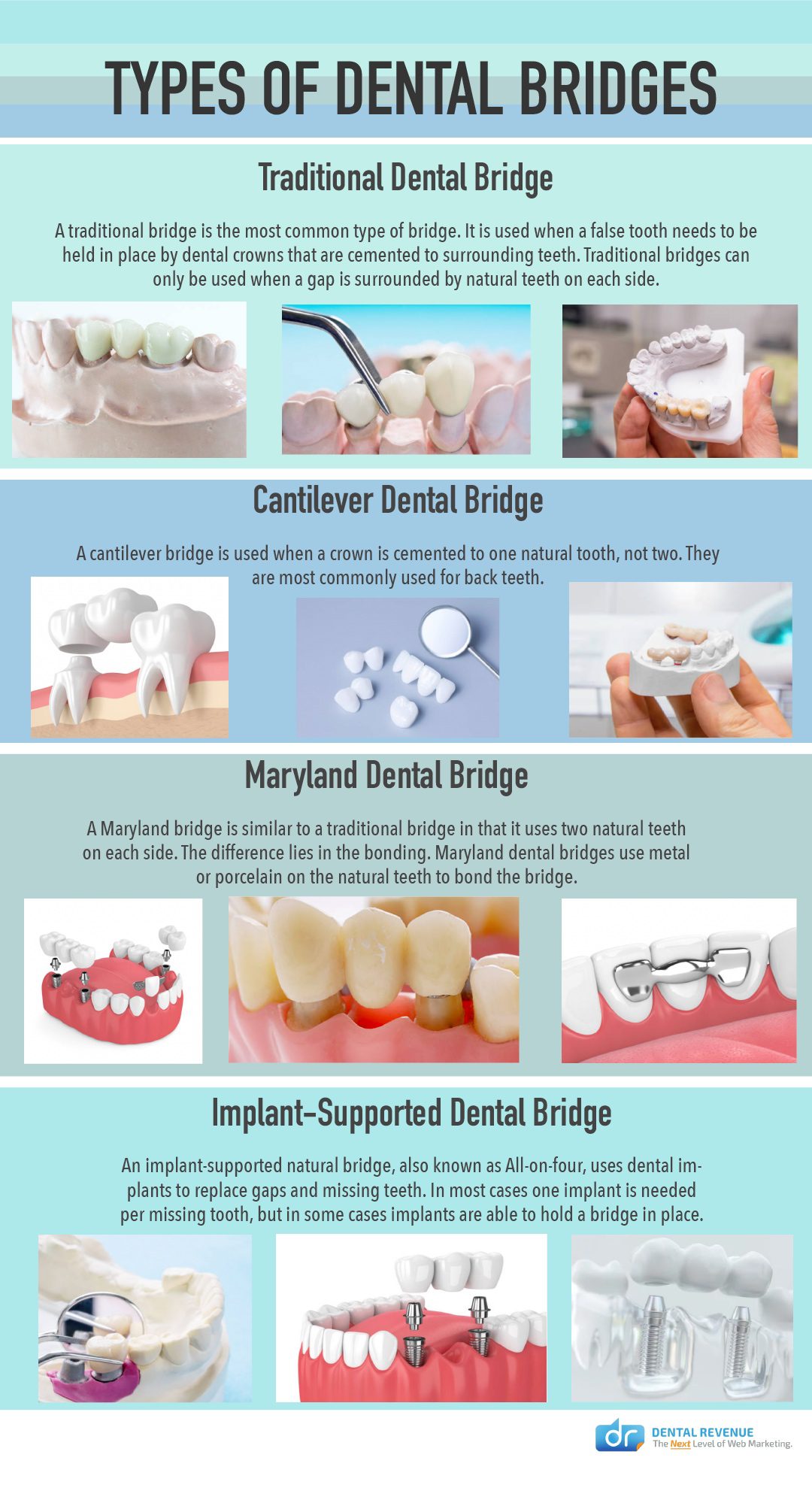 Dental Bridges Front Teeth