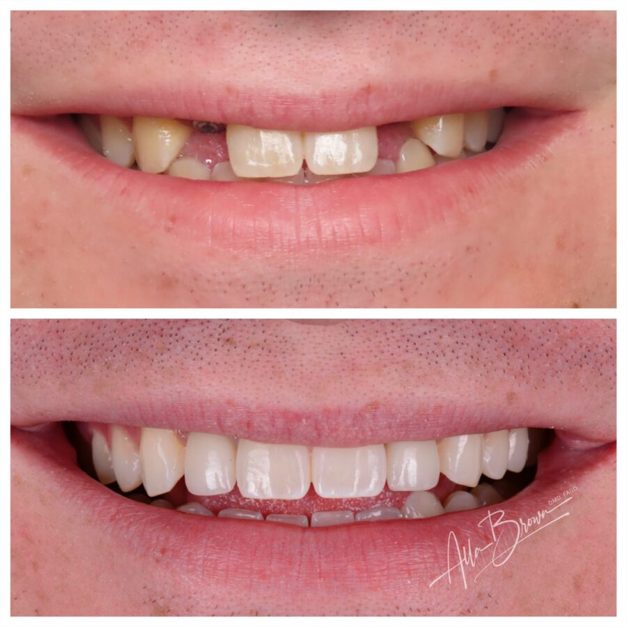 Main Gallery Image 1 | Dental Implant Cases