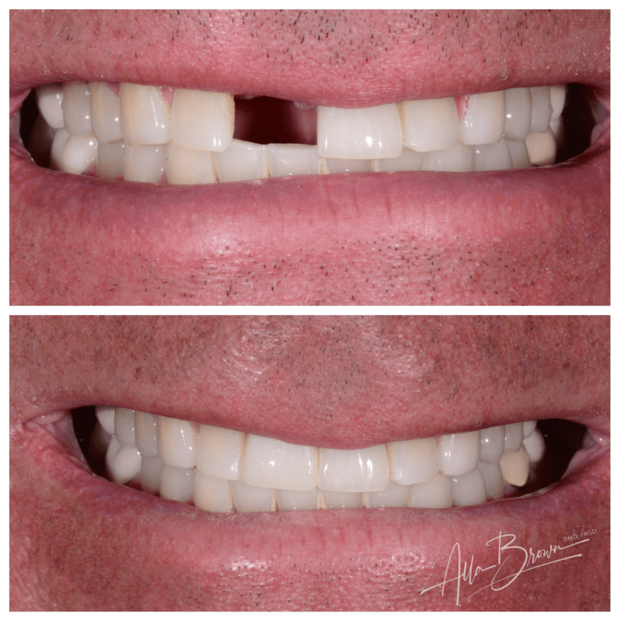 Main Gallery Image 2 | Dental Implant Cases