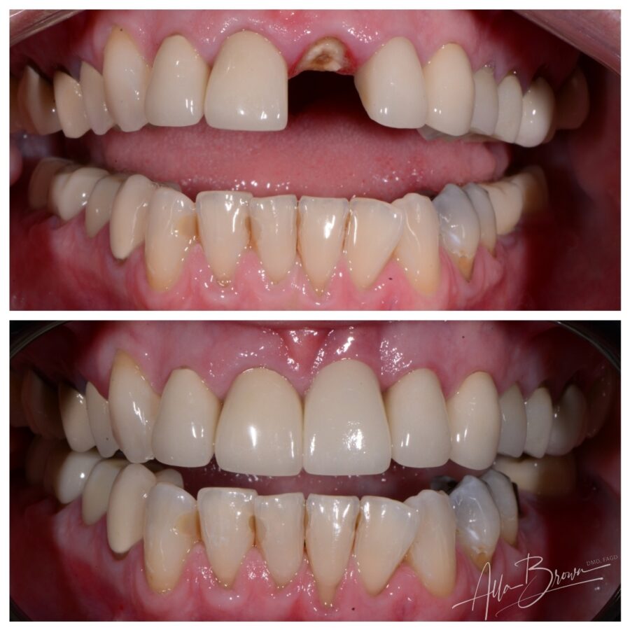 Main Gallery Image 5 | Dental Implant Cases