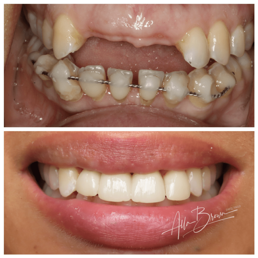 Main Gallery Image 6 | Dental Implant Cases