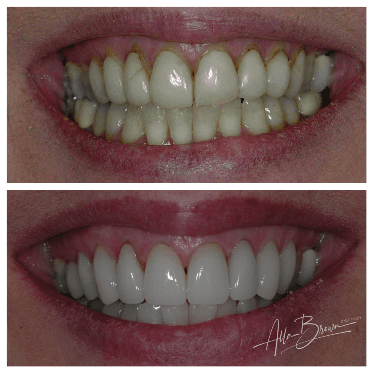 Porcelain Veneers Smile Gallery for Buford, GA Dentist