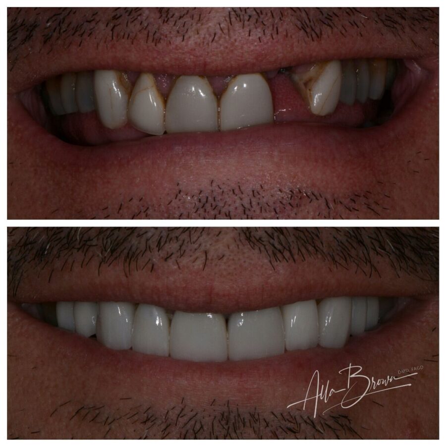 Main Gallery Image 3 | Dental Implant Cases