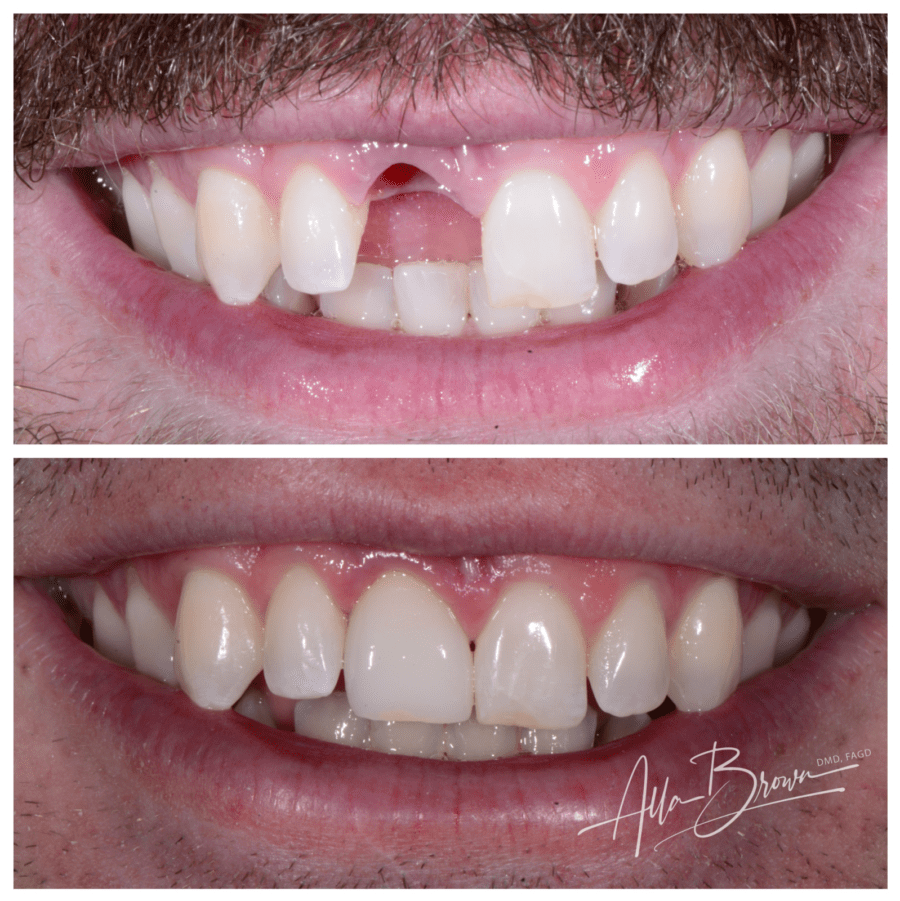 Main Gallery Image 4 | Dental Implant Cases