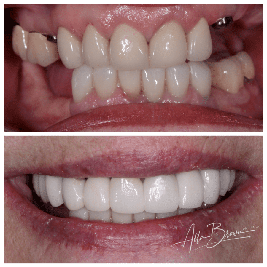 Main Gallery Image 7 | Dental Implant Cases